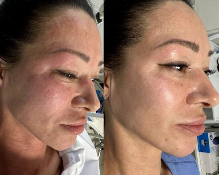 exosomes-microneedling-treatment-result-1