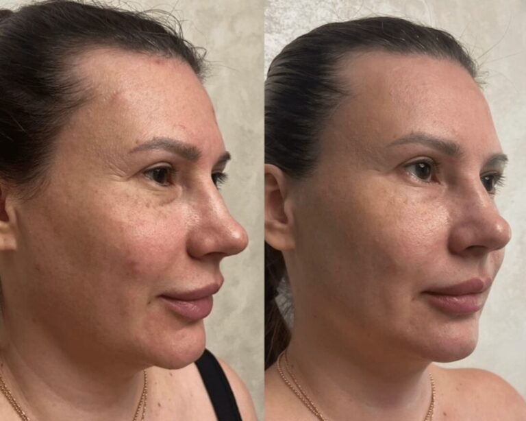 exosomes-microneedling-treatment-result-2