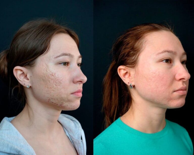 exosomes-microneedling-treatment-result-3