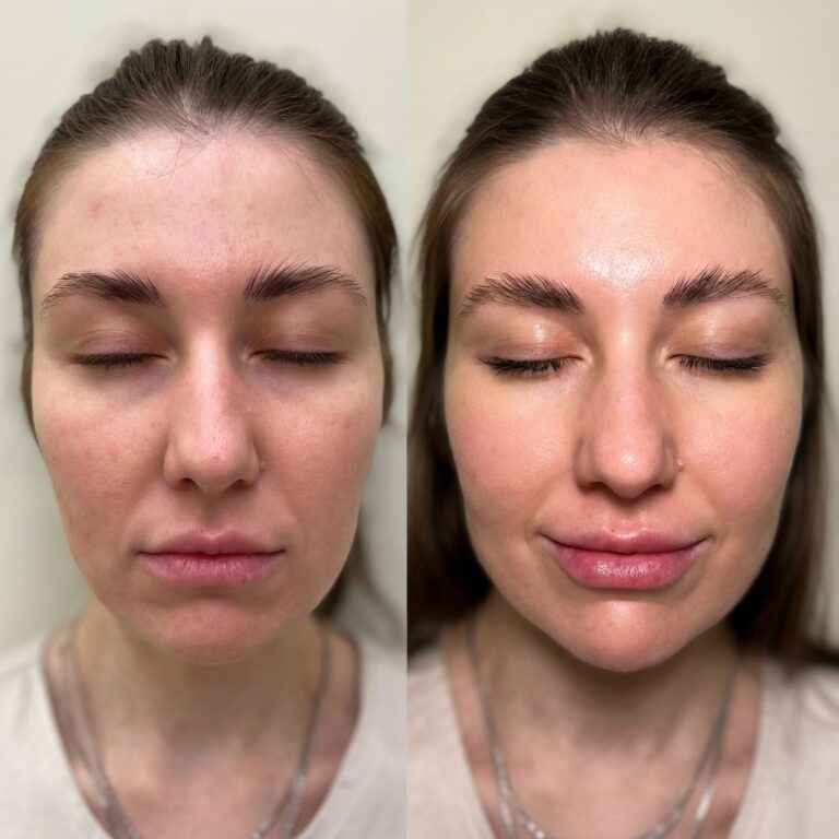 forma-radiofrequency-treatment-result-2