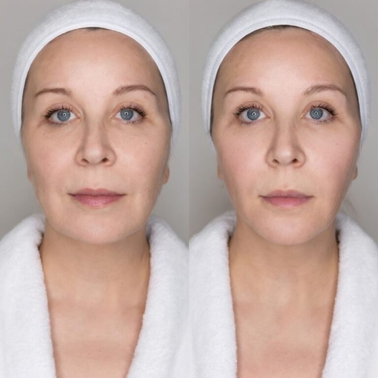 forma-radiofrequency-treatment-result-3