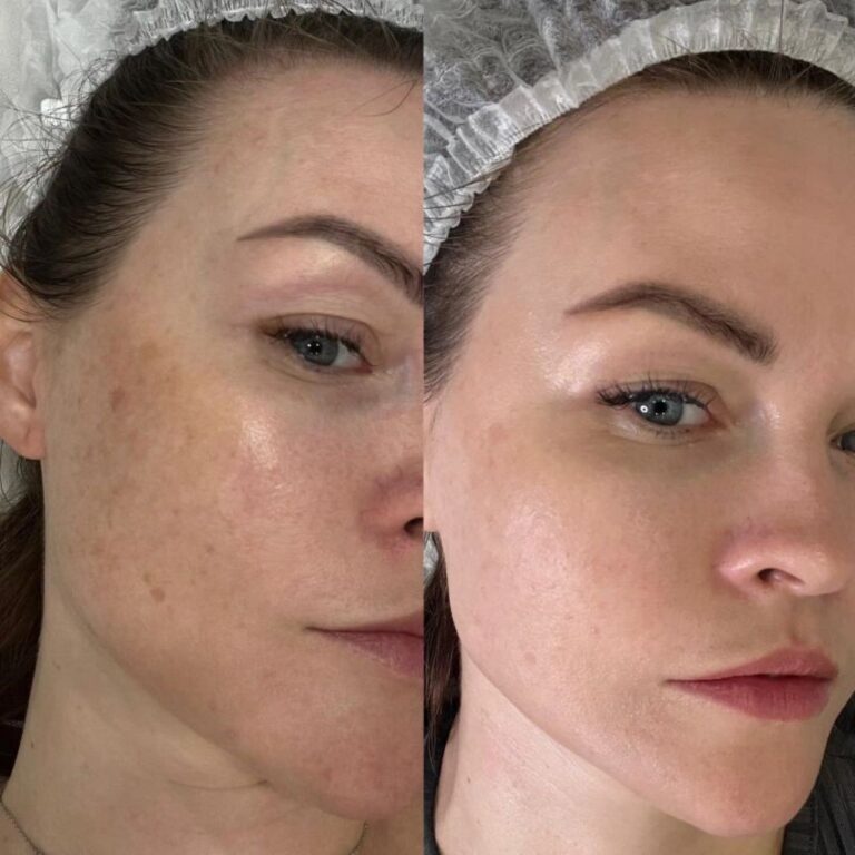 forma-rf-treatment-results-1