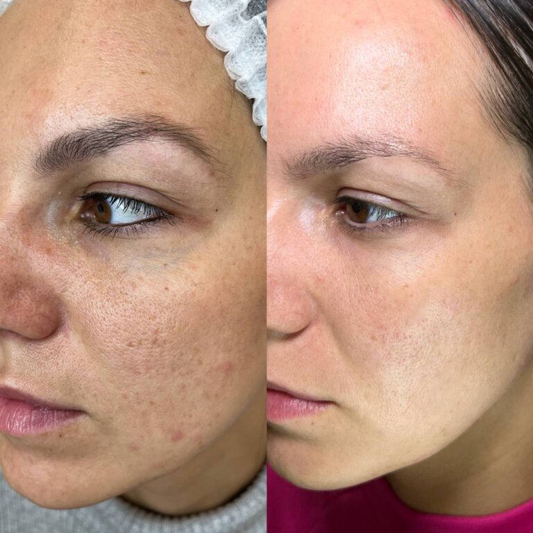 forma-rf-treatment-results-2