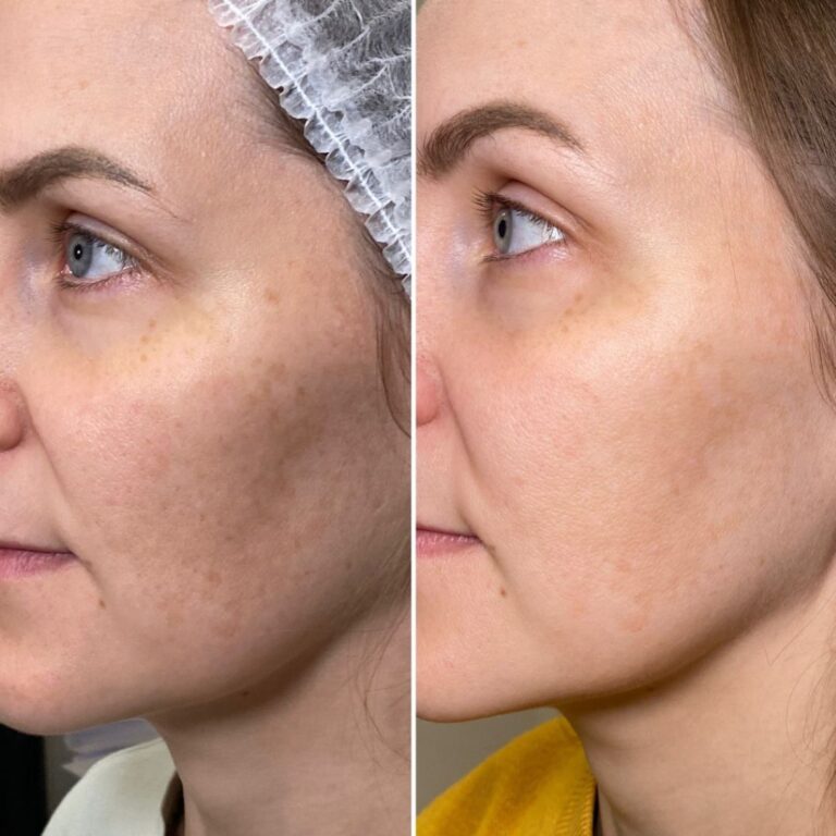 forma-rf-treatment-results-3