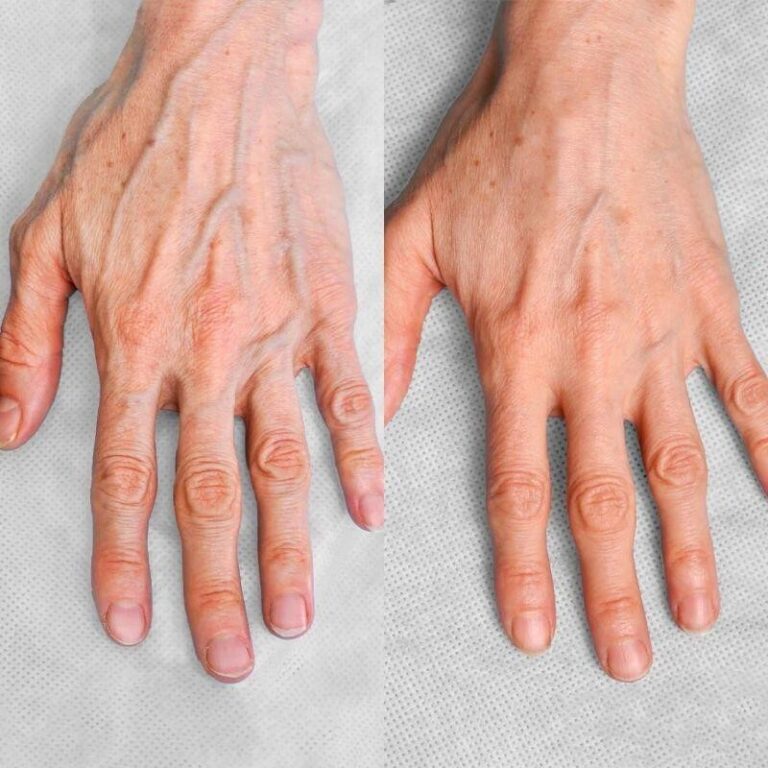hand-rejuvenation-result-1