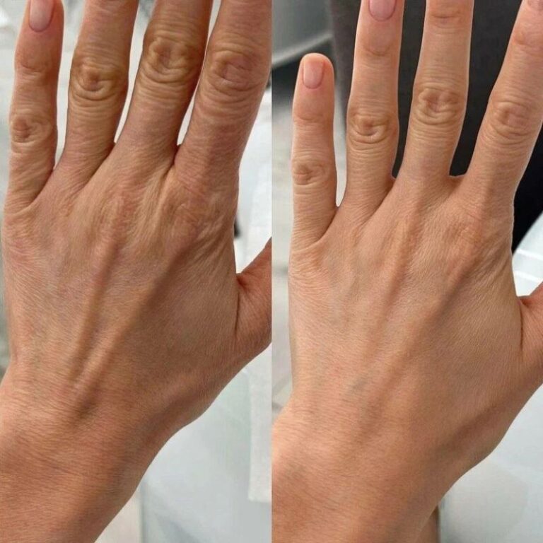 hand-rejuvenation-result-2