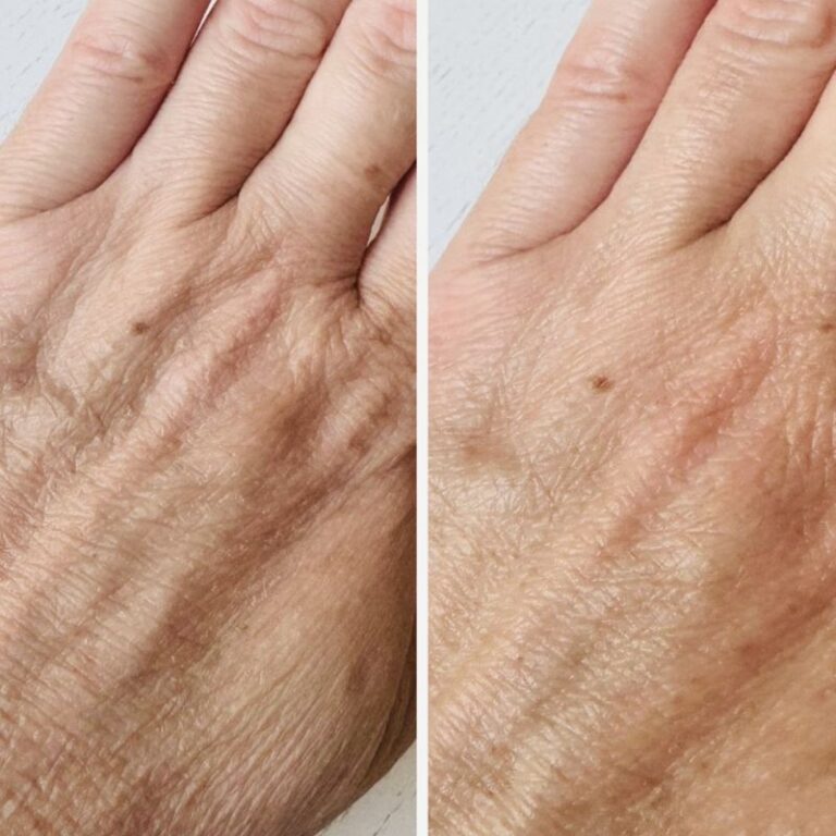 hand-rejuvenation-result-3