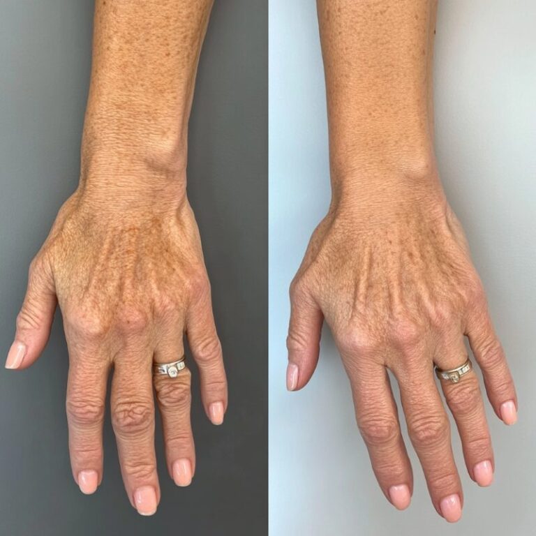 hand-rejuvenation-result-4