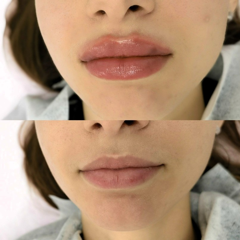 Before and after comparison showing natural lip enhancement results from professional filler treatment in Chelsea
