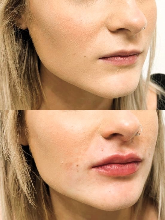 Before and after lip filler treatment results in Camden showing natural volume enhancement and improved lip contour.