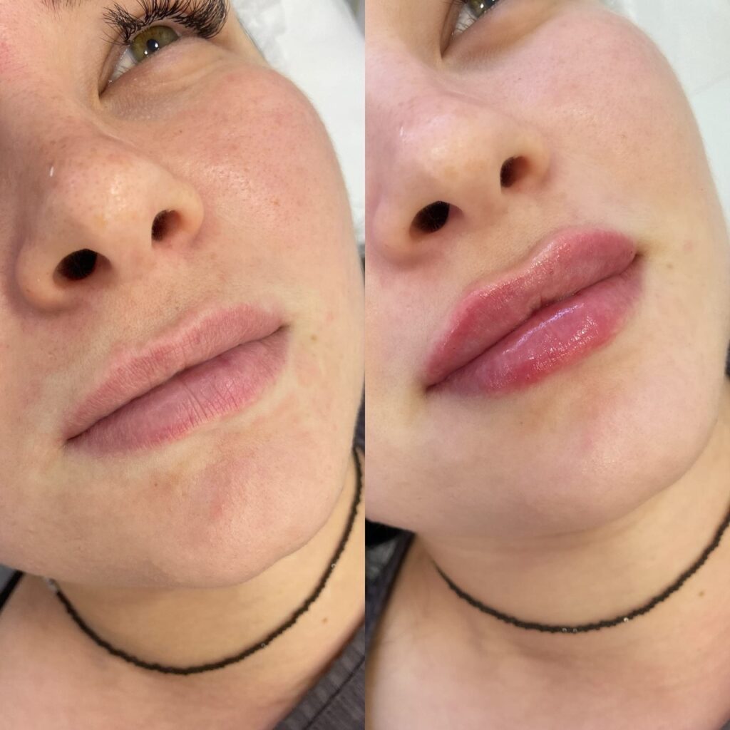 Before and After: Lip Filler Results in Central London