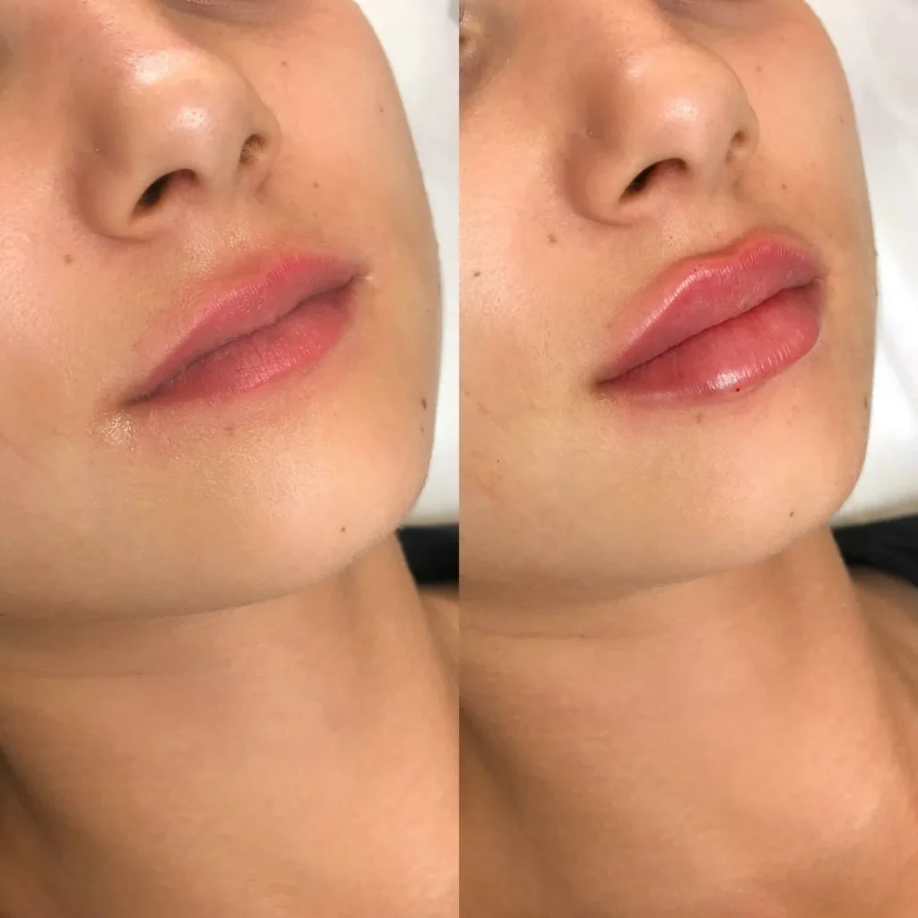 Before and after comparison showing natural lip enhancement results from professional filler treatment.