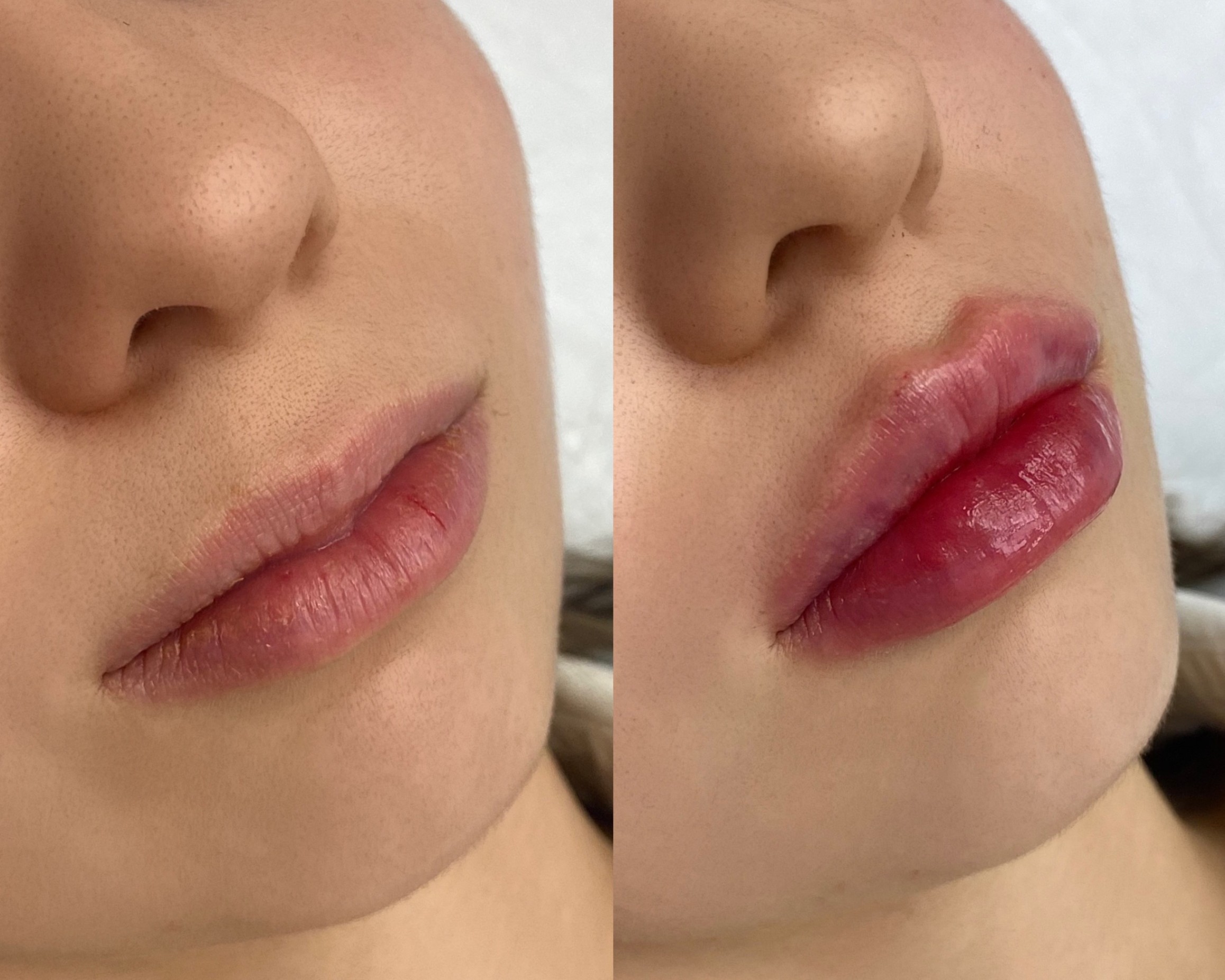 Before and after comparison showing natural lip enhancement results from professional filler treatment in Kensington.