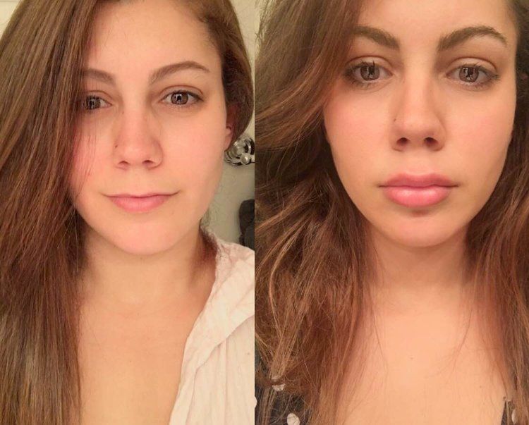 Before and after comparison showing natural lip enhancement results from professional filler treatment in Knightsbridge