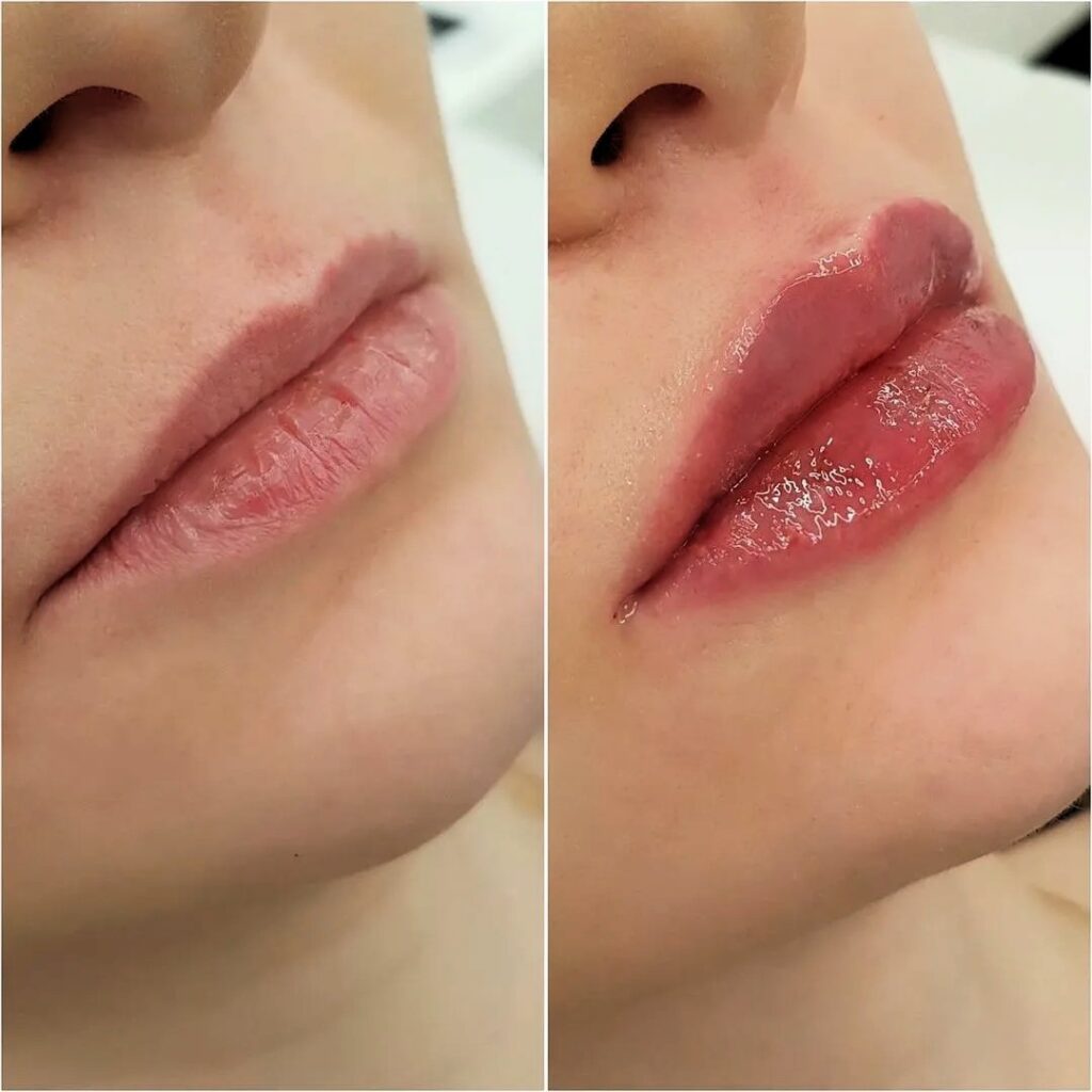Before and after comparison showing natural lip enhancement results from dermal filler treatment.