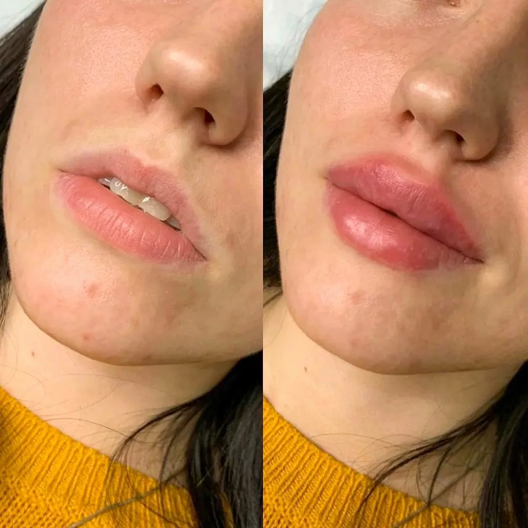 Before and after comparison of lip filler results showing natural volume enhancement and improved lip definition.