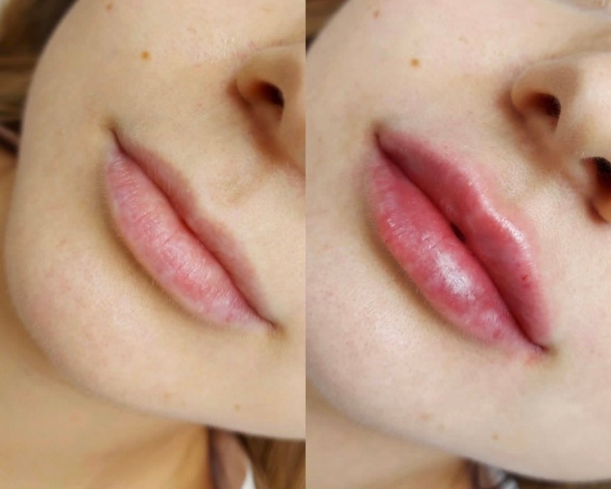 Before and after comparison of lip filler results showing natural volume enhancement and improved lip definition.
