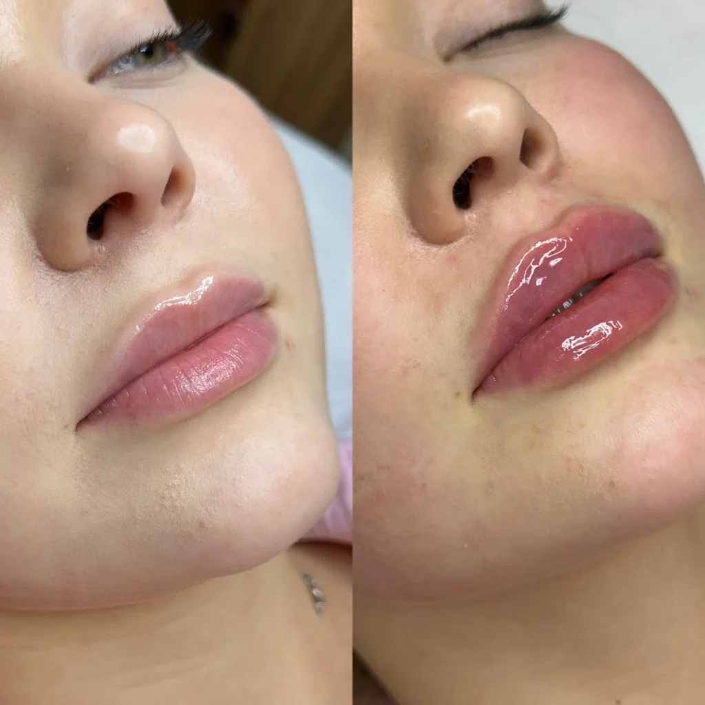 Before and after comparison of natural lip enhancement results following dermal filler treatment in Tyburina.