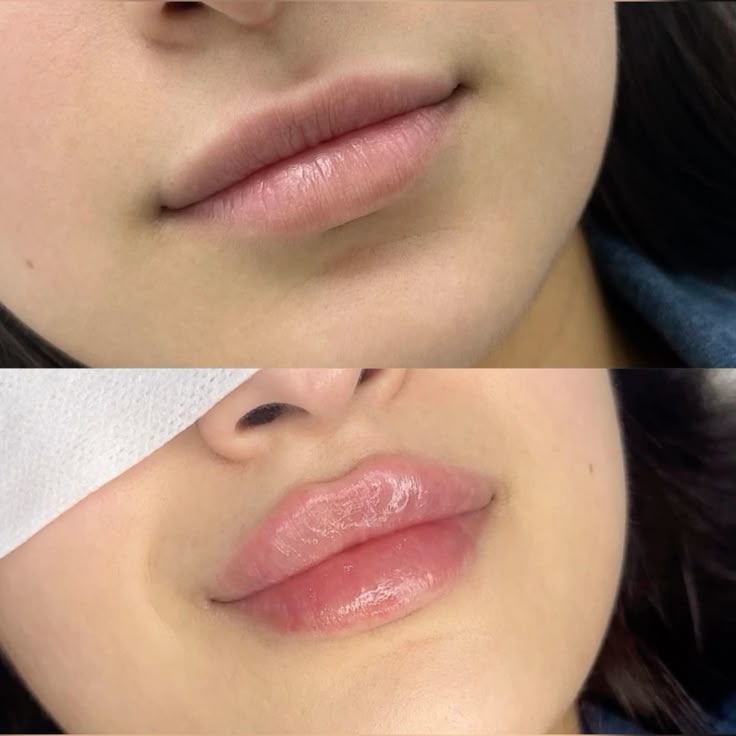 Before and after lip filler results in West End London showing natural volume enhancement and improved lip shape