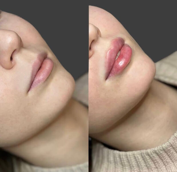 Professional demonstration of systematic lip filler treatment process and clinical procedure steps.