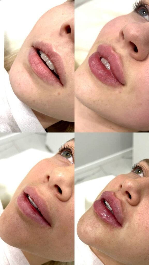 Woman displaying professional lip filler treatment results in clinical photography setting.