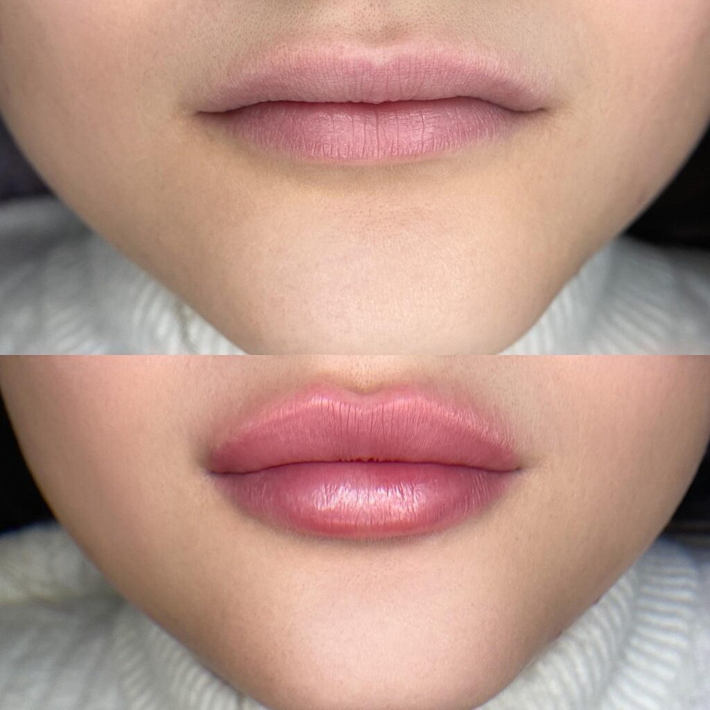 Step-by-step lip filler treatment process explained by expert practitioners in West End London clinic