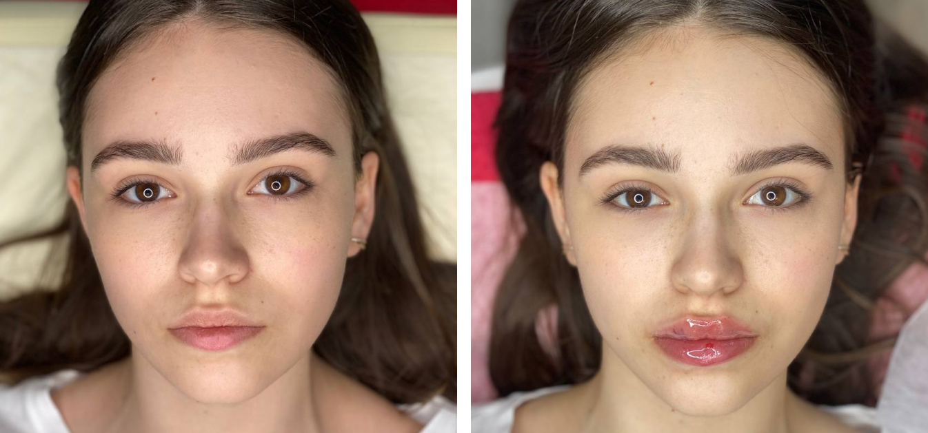 Patient during lip filler treatment process showing step-by-step consultation results in Westminster clinic.