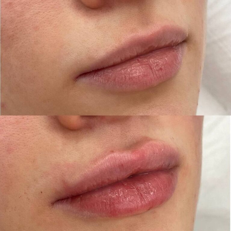 russian-lips-results-1