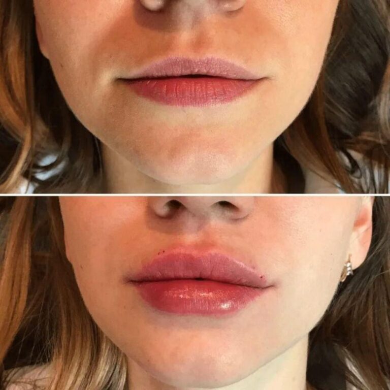 russian-lips-results-3