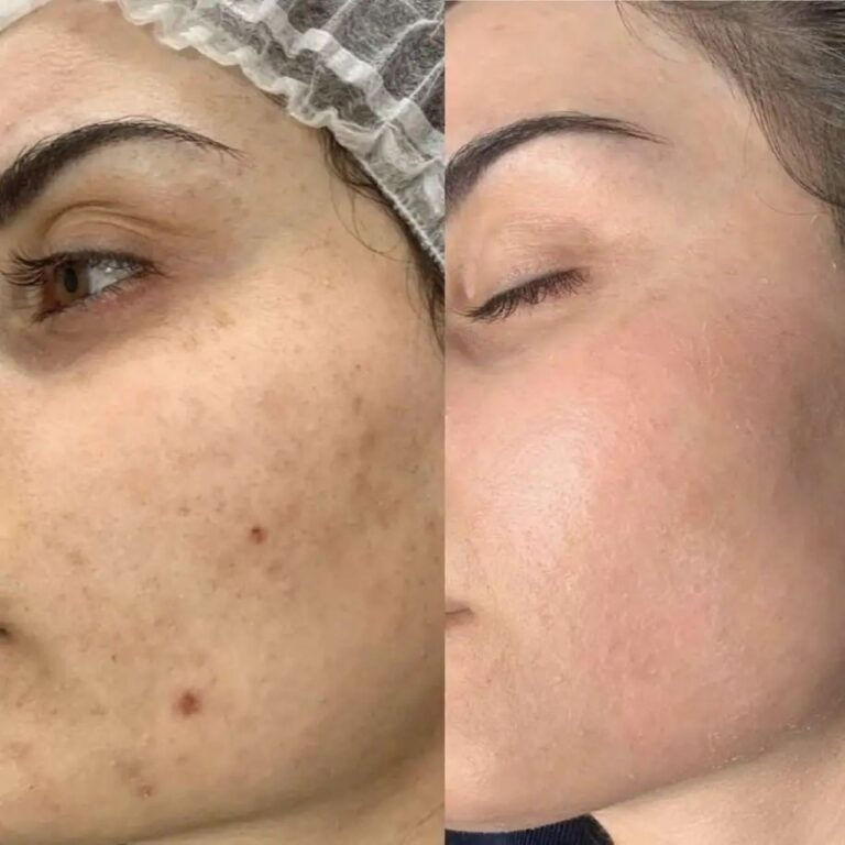 transformation-dermalux-led-results-1