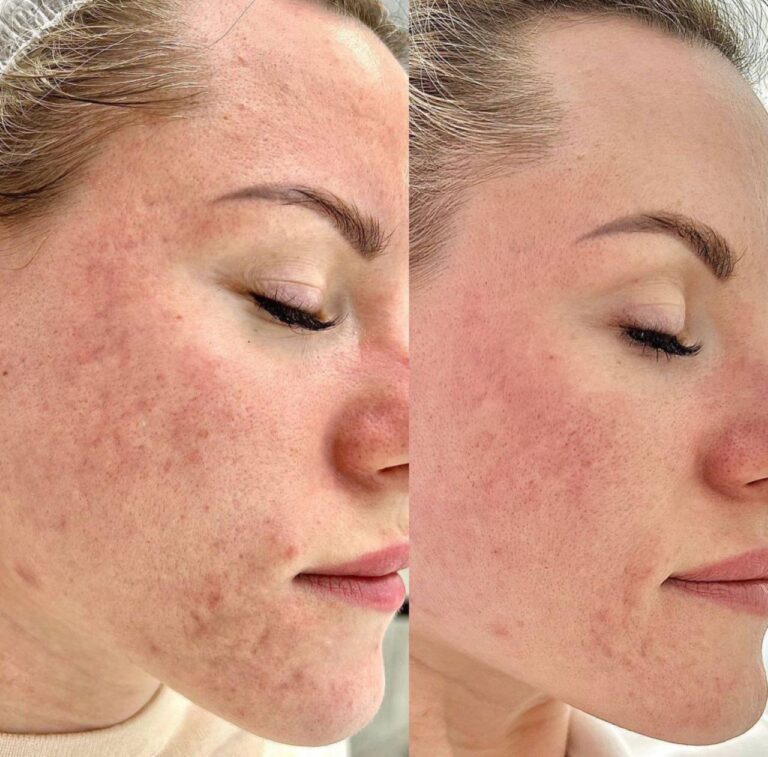 transformation-dermalux-led-results-3