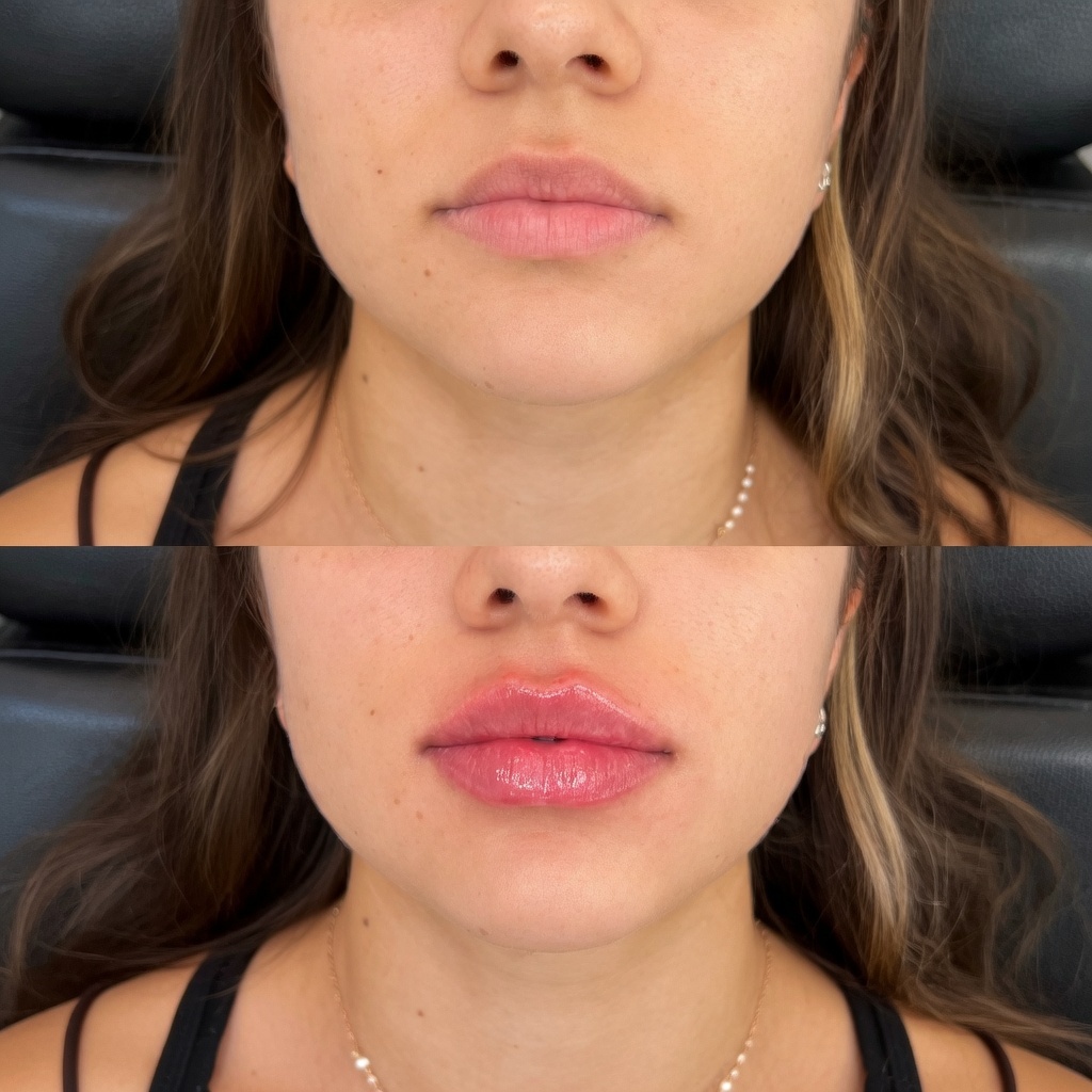 Confident patient with natural lip enhancement results demonstrating expert clinic care and quality treatment