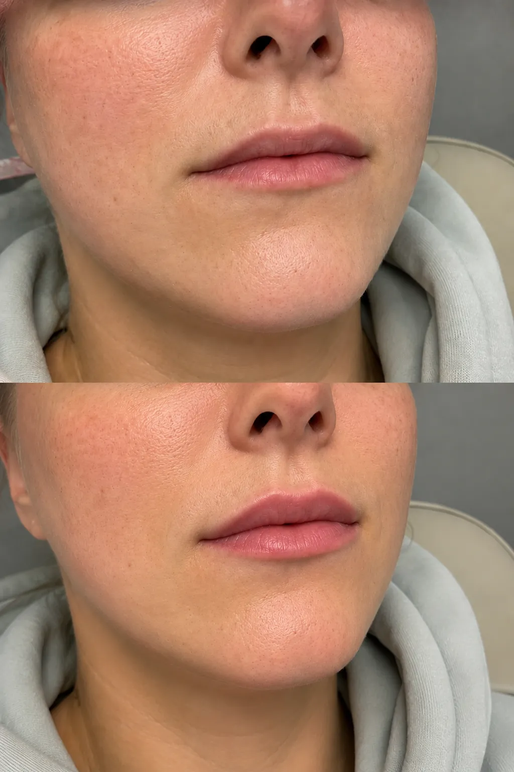 0.5ml lip filler treatment in a London clinic for subtle lip enhancement and natural-looking volume