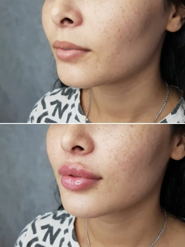 Before and after Cupid’s bow lip filler treatment showing enhanced lip contour and definition