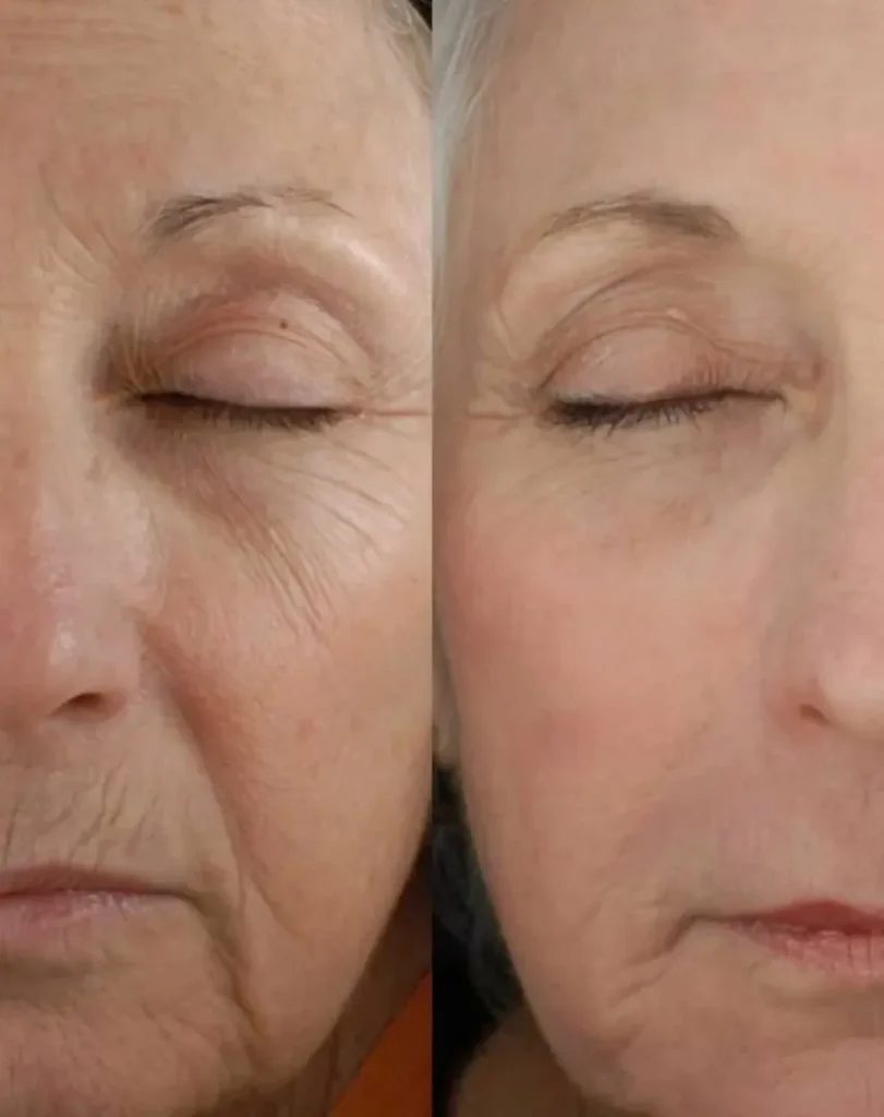 Before and after Ellansé filler treatment showing restored facial volume and smoother contours