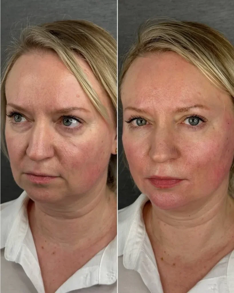 Before and after Rejuran polynucleotide treatment showing improved skin texture, elasticity, and radiance