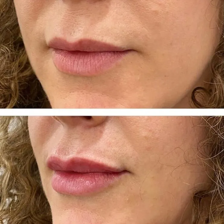Before and after 0.5ml lip filler treatment showing subtle enhancement and improved lip definition