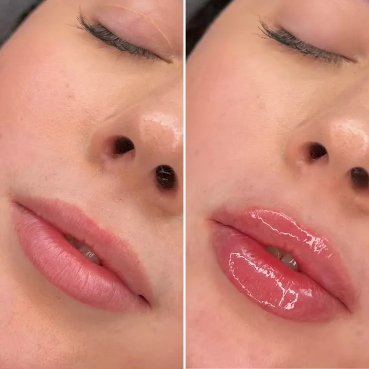 Before and after butterfly lip filler treatment showing enhanced lip contour and balanced volume