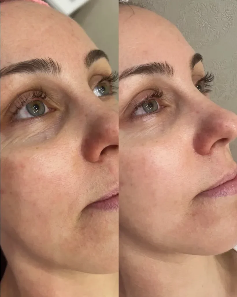 Benefits of Ellansé filler treatment, including facial rejuvenation, collagen stimulation, and long-lasting results