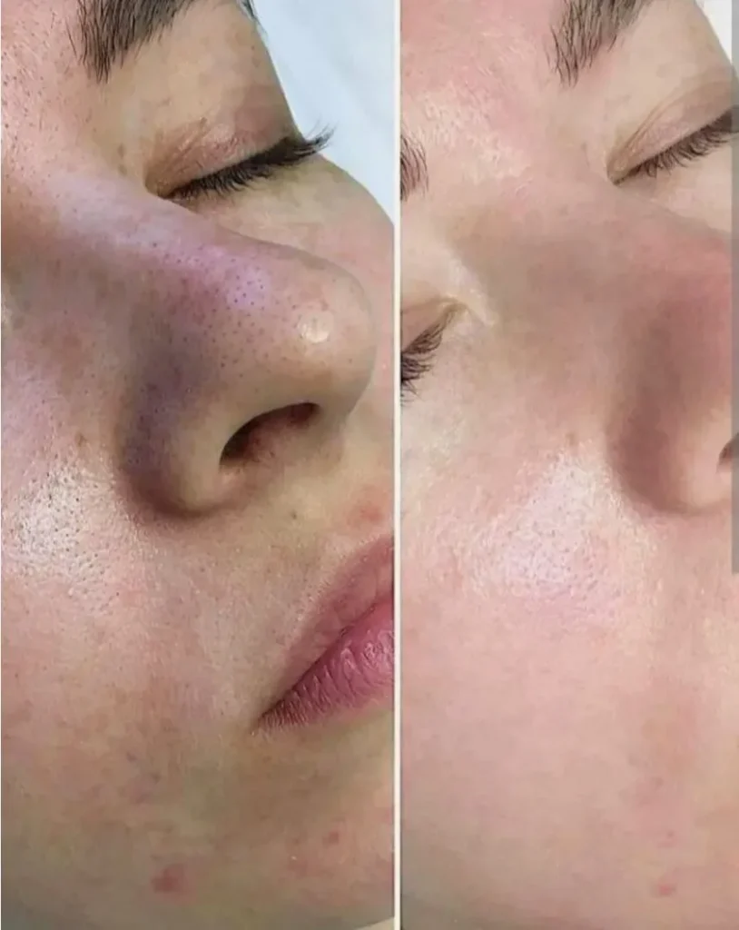 Benefits of Rejuran polynucleotide treatment, including skin repair, hydration, and improved elasticity