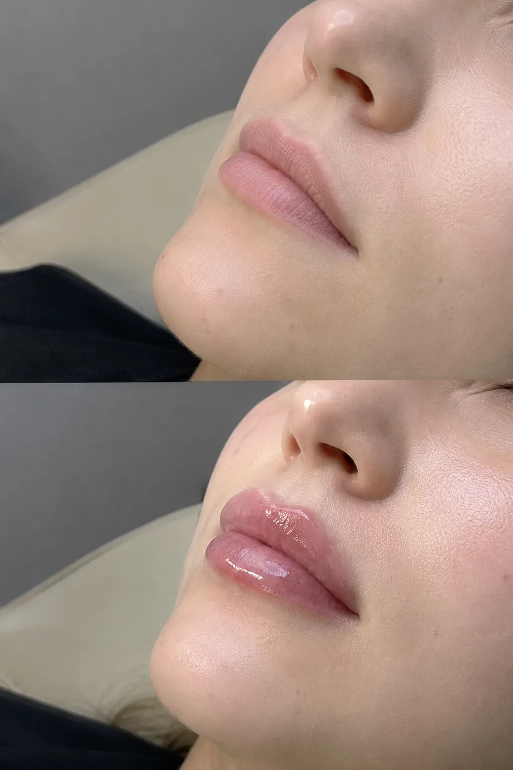 Butterfly lip filler treatment in a London clinic to enhance lip shape, definition, and volume