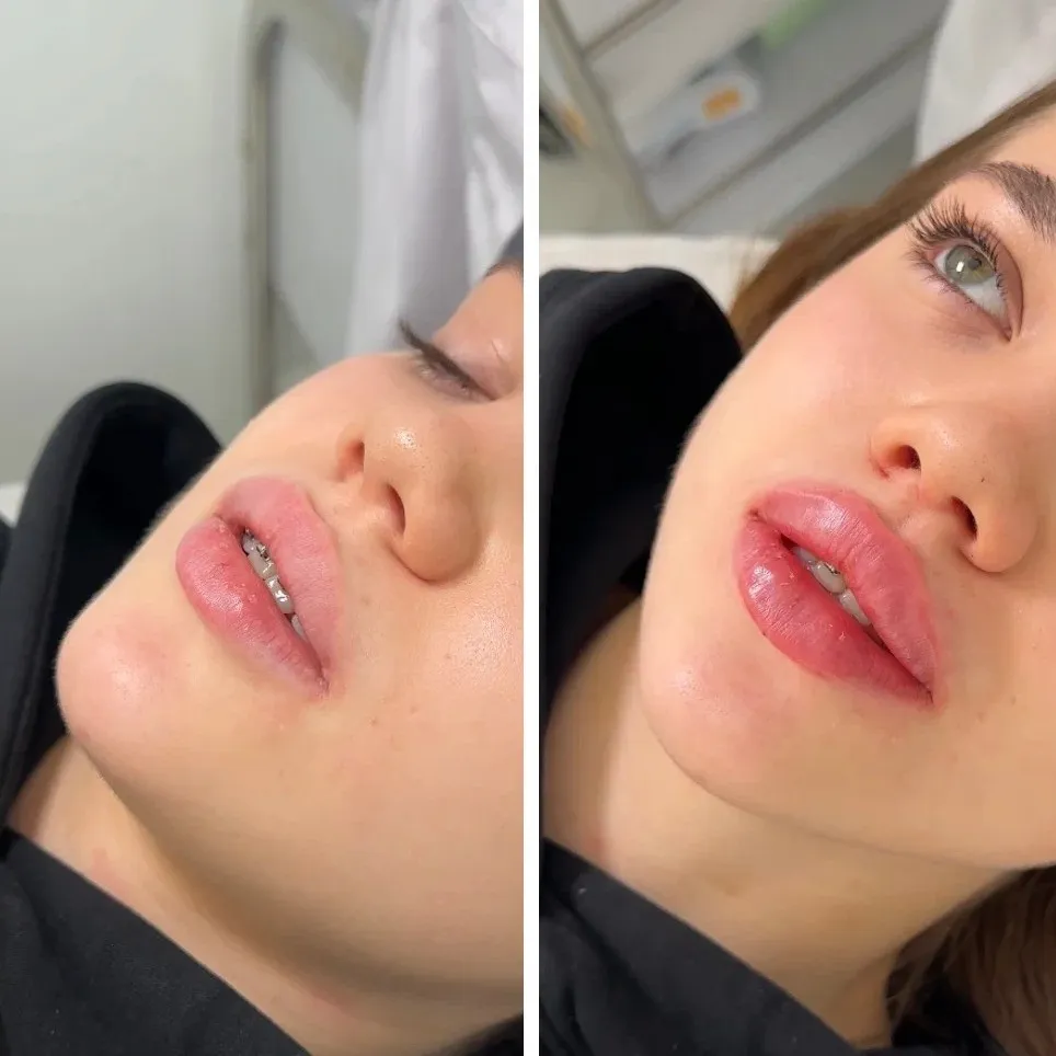 Butterfly lip filler treatment options tailored for lip enhancement and facial balance
