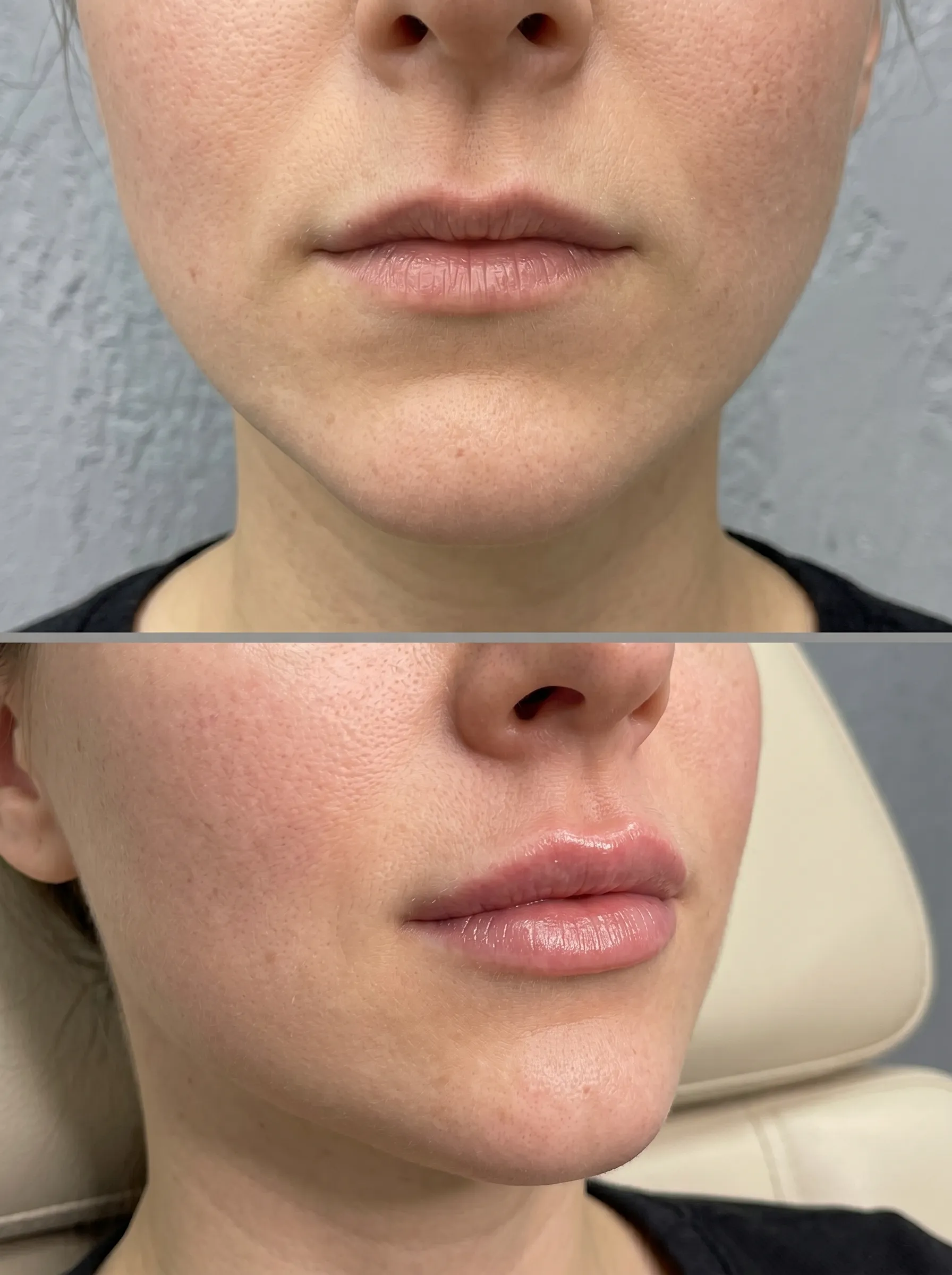 Cupid’s bow lip filler treatment in a London clinic to enhance lip shape and definition