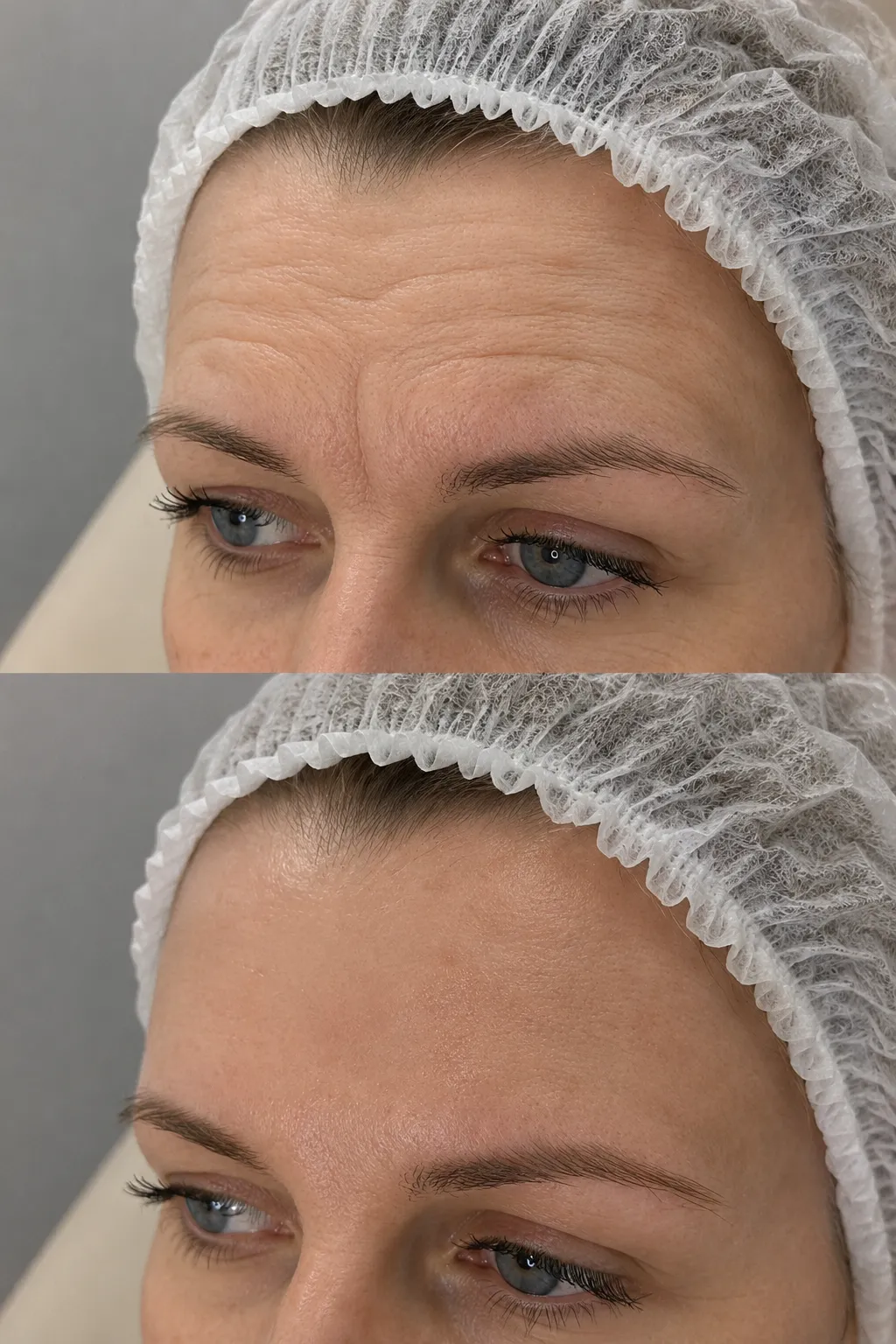 Forehead wrinkle relaxing treatment in a London clinic to reduce forehead lines and smooth expression wrinkles