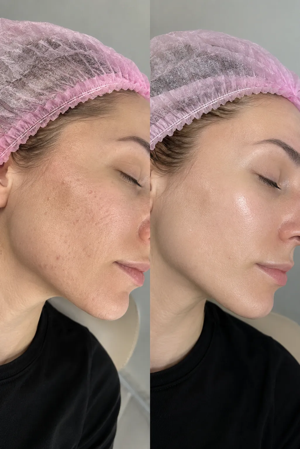Jalupro treatment in a London clinic for skin hydration, collagen stimulation, and rejuvenation