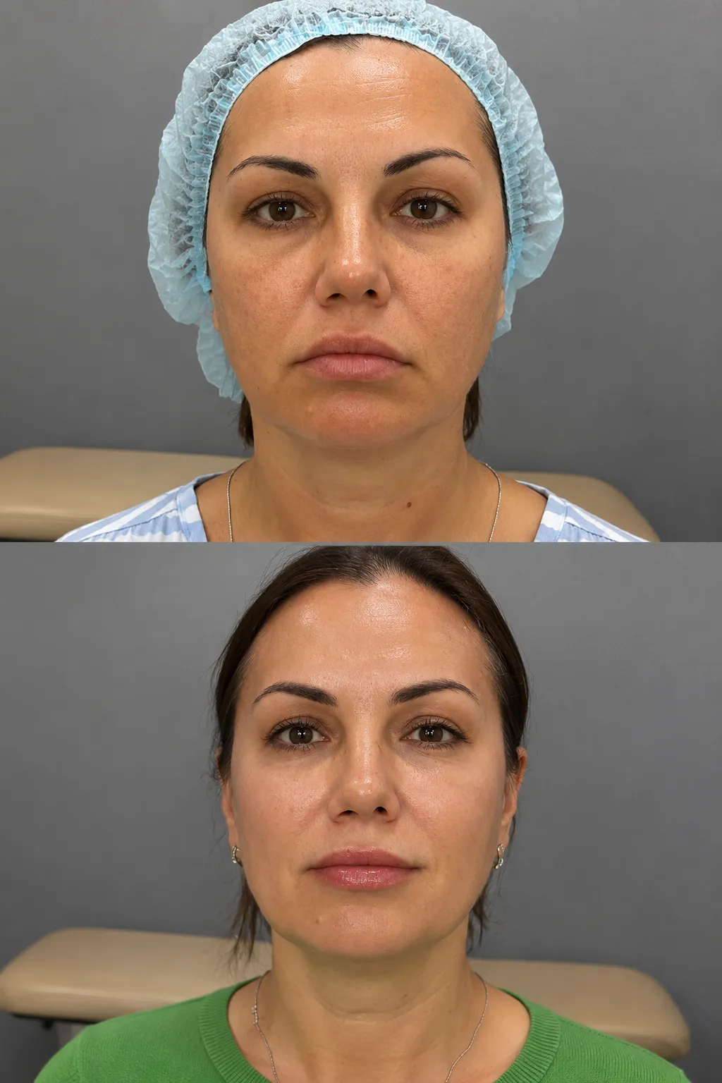 Plinest polynucleotide treatment in a London clinic for skin regeneration and rejuvenation