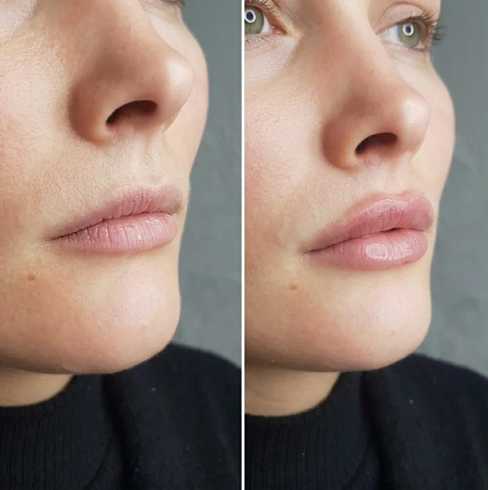 Lip filler treatment focused on defining and enhancing the Cupid’s bow for balanced lip aesthetics