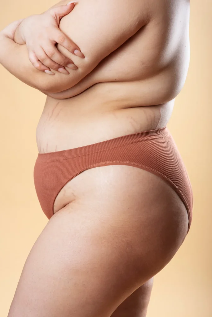 Stretch marks visible on abdomen, thighs, and hips before cosmetic skin treatment.