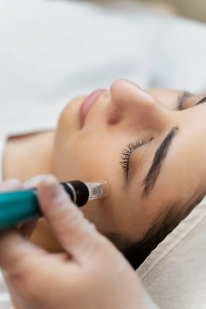 Close-up of microneedling procedure on facial skin showing a professional performing treatment with a microneedling pen