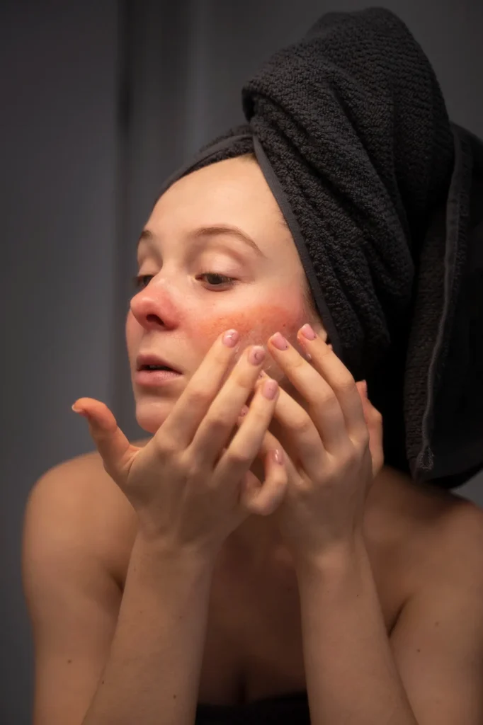Woman examining slightly red skin after microneedling treatment during the early recovery and healing phase